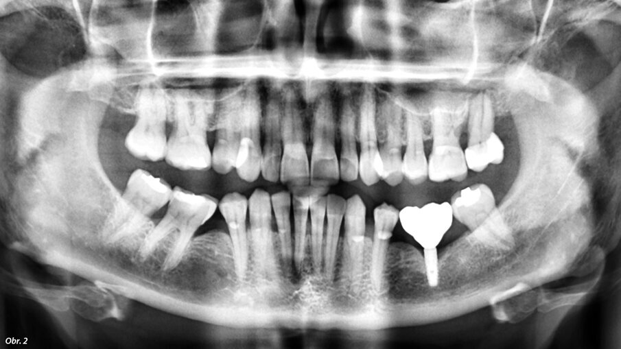 Iniciační rentgenový snímek před začátkem ošetření.