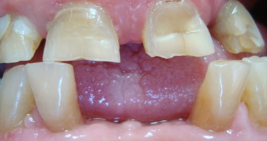 Treatment of drug-induced gingival enlargement with Er:YAG laser
