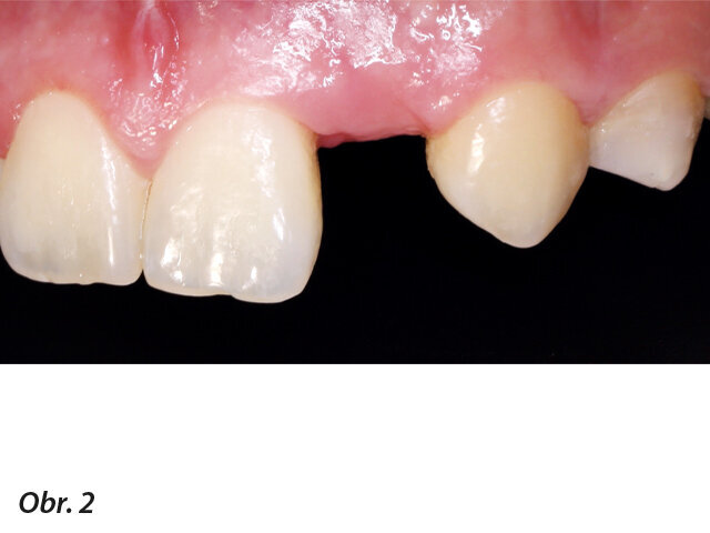 Obr. 1, 2: Horní zuby pacientky před ošetřením.