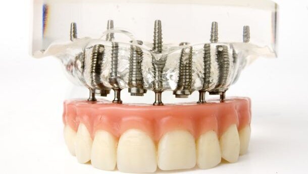 Diabetes toch geen invloed op implantaatgenezing