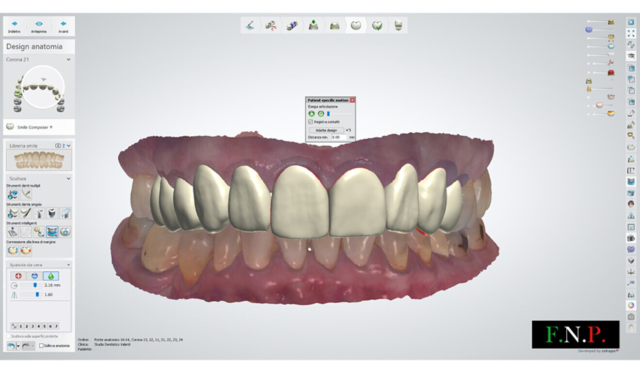 Fig. 11: CAD of the denitive restorations.