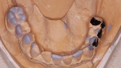 Implantoprotetyczna rehabilitacja braków skrzydłowych z pełną odbudową estetyczną