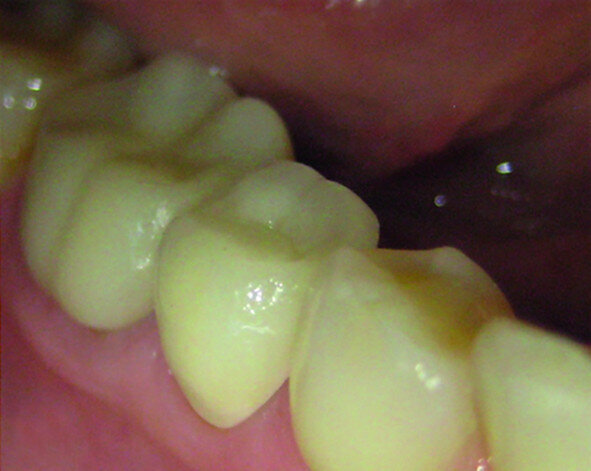 Fig. 7b: 3D printed model for fabrication of the stratified zirconia crown in the laboratory (a). Zirconia crown set in the mouth (b).