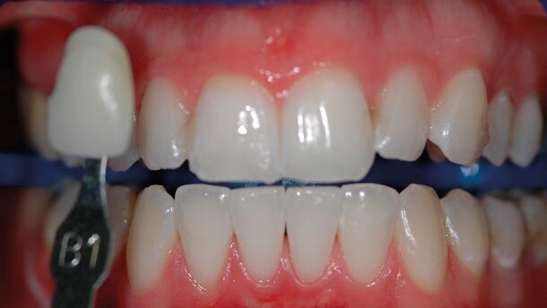 Valutazione clinica degli agenti sbiancanti professionali al 6% e al 25% di perossido di idrogeno su denti vitali