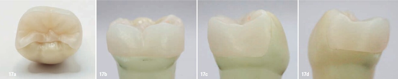 Figs. 17a–d: Pinlay seated on the prepared dentoform tooth, shown in the occlusal (a), lingual (b) and proximal views (c & d).