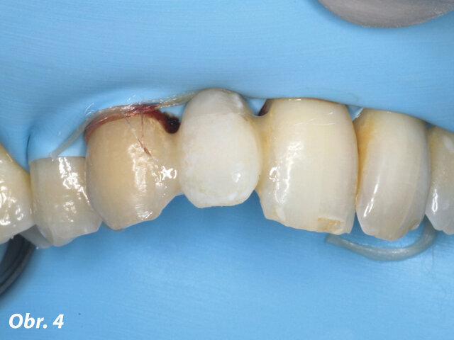 Obr. 4: Extrahovaný zubní fragment (obr. 3) připevněný k sousedním zubům jako provizorní rekonstrukce