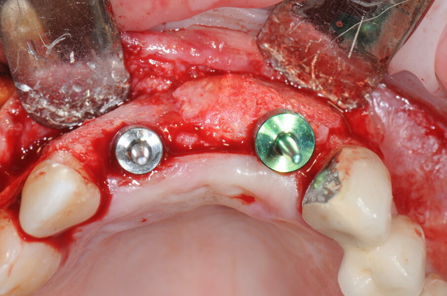 Fig. 17 - Preparazione del sito implantare; impianti Blossom Intra-Lock.