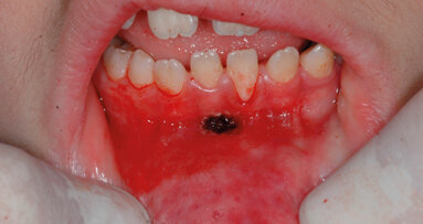 Vantaggi dell’utilizzo di un laser a Er:YAG: nella chirurgia pedodontica