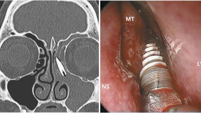 Zdravniki našli zobni implantat v nosni votlini