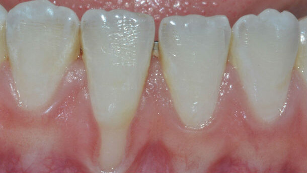 Chirurgia plastica parodontale opzioni terapeutiche nel trattamento estetico delle recessioni gengivali