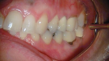 Een 37-jarige follow-up van een endodontisch behandeld element met een perforatie