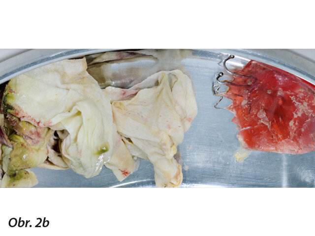 Použité gázové krytí a plochá akrylová deska s kovovými sponami