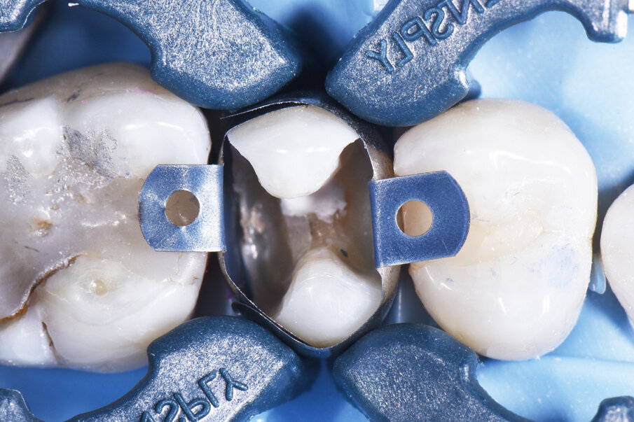 Palodent® V3 sectional matrix set-up showing a re-creation of an ideal line angle anatomy all in one solution.