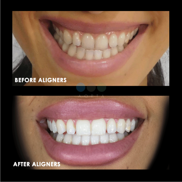 Figs. 38a & b: Patient’s smile (a) before and (b) after aligner treatment.