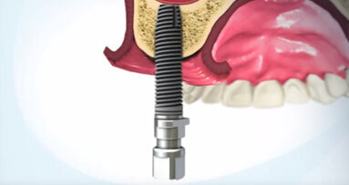 Minimally invasive sinus lift with iRaise