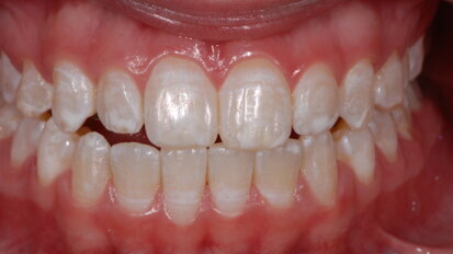 Los efectos adversos del aclaramiento dental