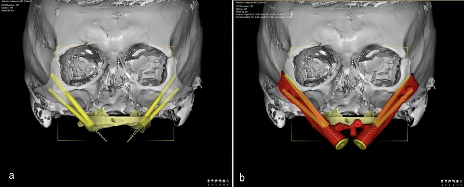 Figs. 4a & b: Digital workflow for simultaneous placement of zygomatic implants and Le Fort I osteotomy designed in DDS-Pro.