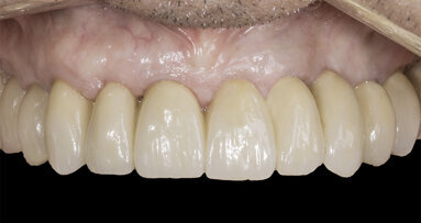 Implant maintenance care solution