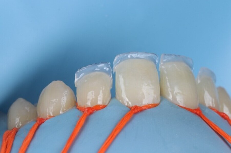 Fig. 3g: Palatal shell created on all 4 upper  incisal teeth.