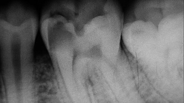 Anatomie du canal radiculaire de la première molaire mandibulaire définitive Implications et recommandations cliniques