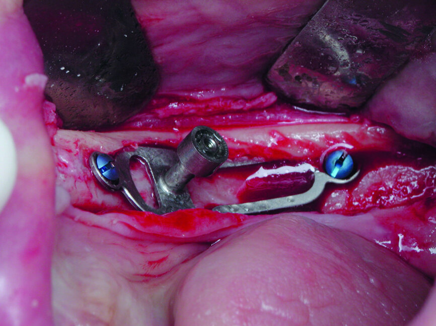 Cas 2b :Verrouillage de l’implant par insertion dans sa logette, et fixation à l’aide de 2 vis d’ostéosynthèse