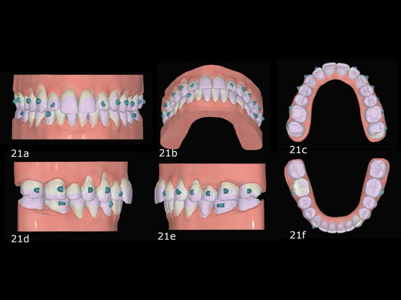 Figs. 21a–f: Comparison of the evolution between the position before the second phase of aligner treatment (purple) and the expected final position (white) in FAS OcclusalDesign.