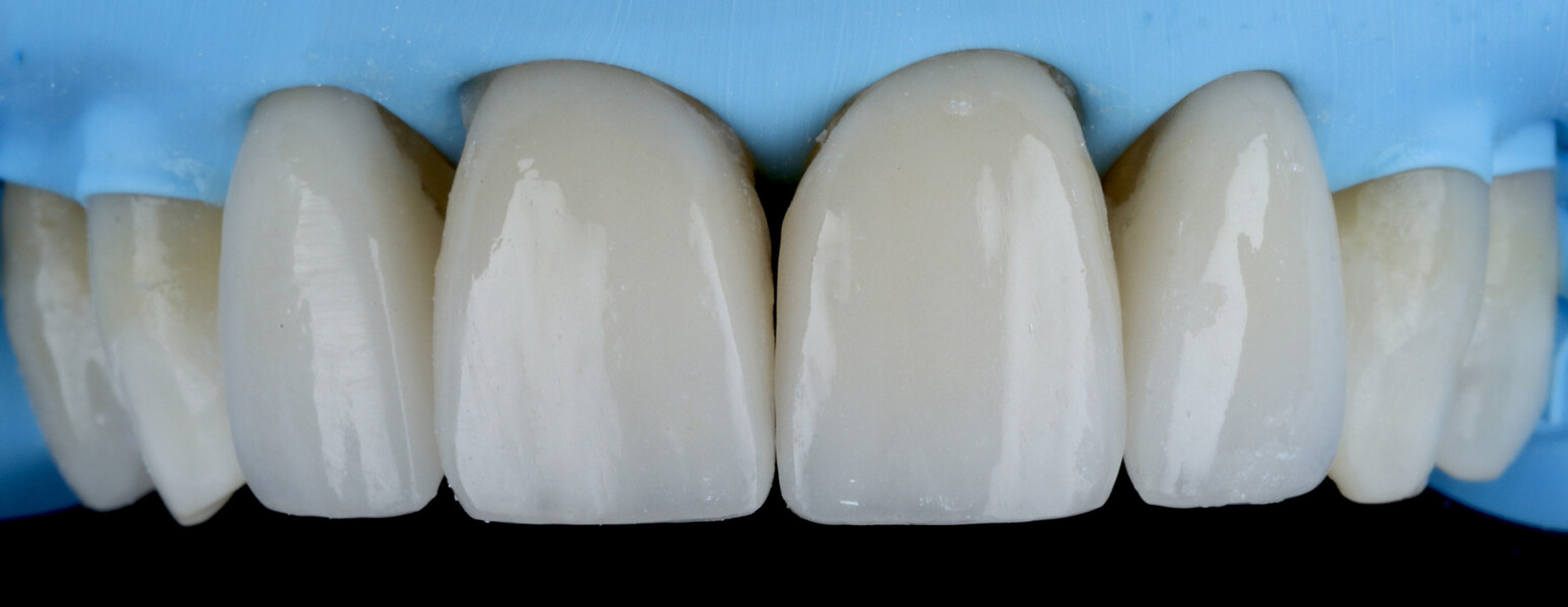 Fig. 21c: Final appearance after interproximal cleaning with floss and removal of excess material.