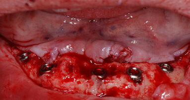 Tiologic Implants – Zirconia monolitica ceraMotion Zr ricostruzione fissa totale su impianti