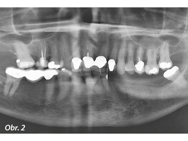 Obr. 2: Panoramatický rentgenový snímek demonstrující počáteční dentoalveolární stav