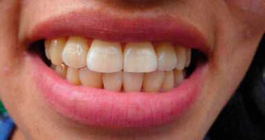 Genetica e morfologia degli sherpa del Nepal: allo studio tramite saliva ed impronte dentali