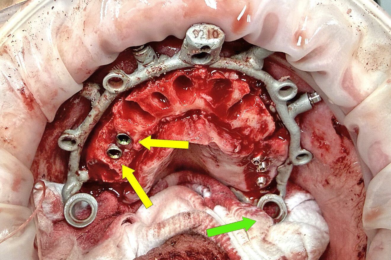 Fig. 18: Retracted intra-oral view after removal of the bone reduction and timing jig, showing the two pre-existing maxillary implants (yellow arrows) and the gauze throat packing (green arrow), indicating possible interference with positioning of the modular guide system components.