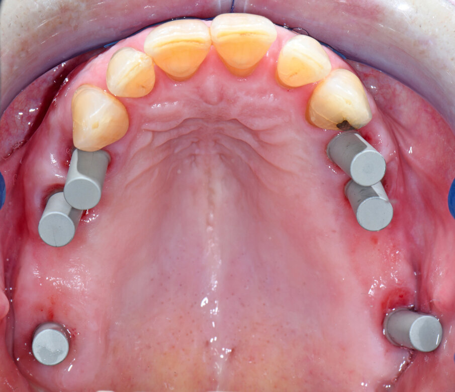 Obr. 8: Atlantis IO FLO-S skenovací tělíska nasazená na MultiBase
Abutments EV.