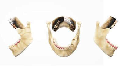 Wykorzystanie interaktywnych modeli 3D na zajęciach z odontologii sądowej dla studentów stomatologii