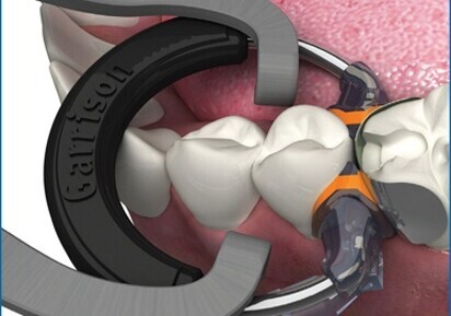 Tight contacts with new separator ring