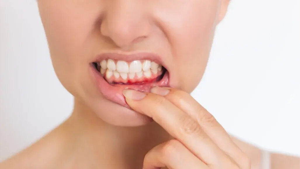 Študija ugotavlja, da parodontoza povečuje tveganje za možgansko kap pri mladih