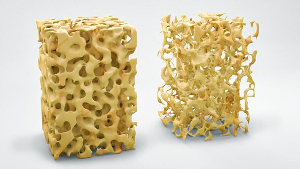 Osteoporosi: gli impianti in magnesio biodegradabili potrebbero promuovere la formazione dell’osso