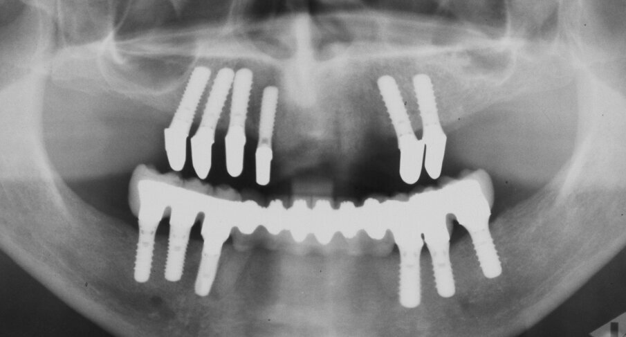 Fig. 15. Orthopantomograph. Final restorations in situ.