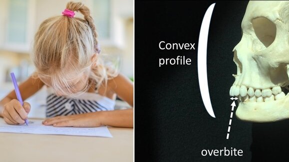 Study confirms link between slender jaws and left-handedness