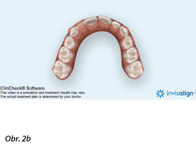 Simultánní expanze všech zubů v oblouku probíhá (b).