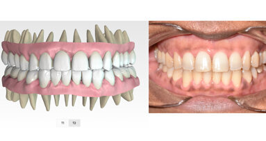 Non-invasive correction of Class III anterior open bite in 7.75 months with clear aligners