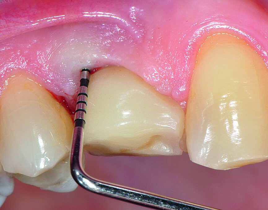 Fig. 1a: Implant in position #14 affected by peri-implantitis: periimplant probing a) with the prosthetic crown in situ and b) after prosthetic crown removal.