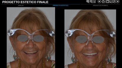 Sviluppo di un progetto interamente digitale dedicato alla protesi totale