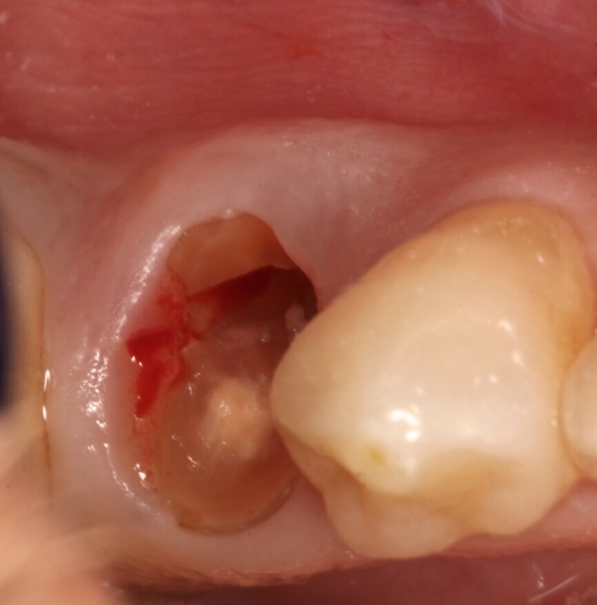 Fig. 2: Sectioned root.