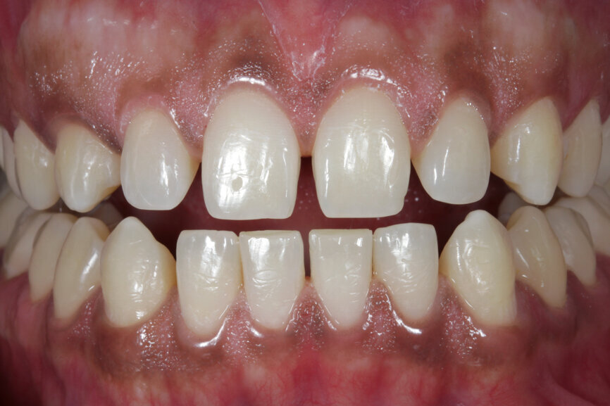 Fig. 1: Initial situation with diastemas in the upper and lower jaws.