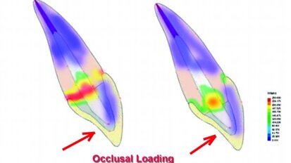 Restauration de dents traitées endodontiquement : un abord sous l’angle technique