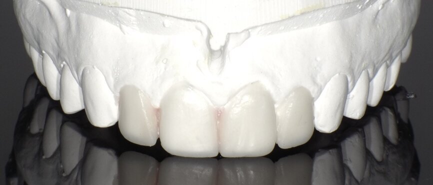 Fig 6:  Indirect wax-up