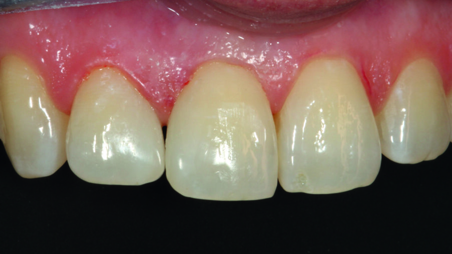 Afbeelding 6. Diasteemsluiting met OMNICHROMA gezien vanuit rechts-lateraal.