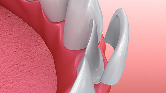 Zahnarzt testet Veneers von Amazon