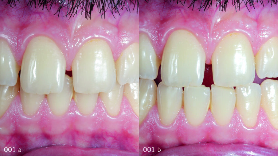 Фиг. 1а, б Първоначалната ситуация. Зъби в интеркуспидация и зъби в протрузия, фронтален изглед.
