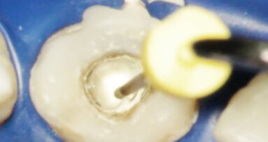 Aplikace MTA s použitím Produit Dentaires (PD) MAP System